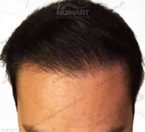 lcf hair transplant|FUE Hair Transplant Philippines .